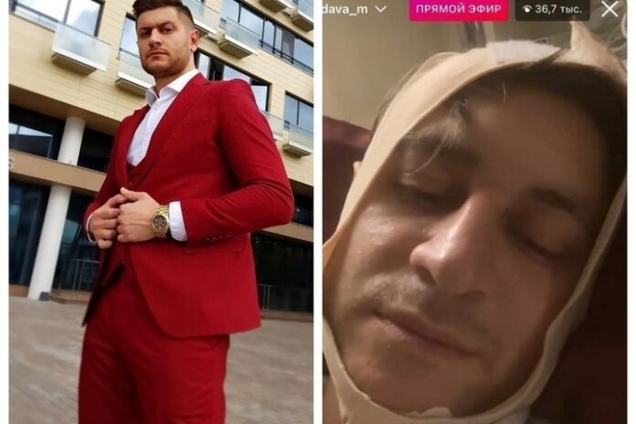 Раскрыта тайна операции Давы: это липосакция