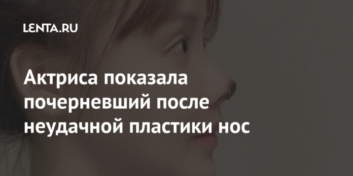 Актриса показала почерневший после неудачной пластики нос: Внешний вид: Ценности: Lenta.ru