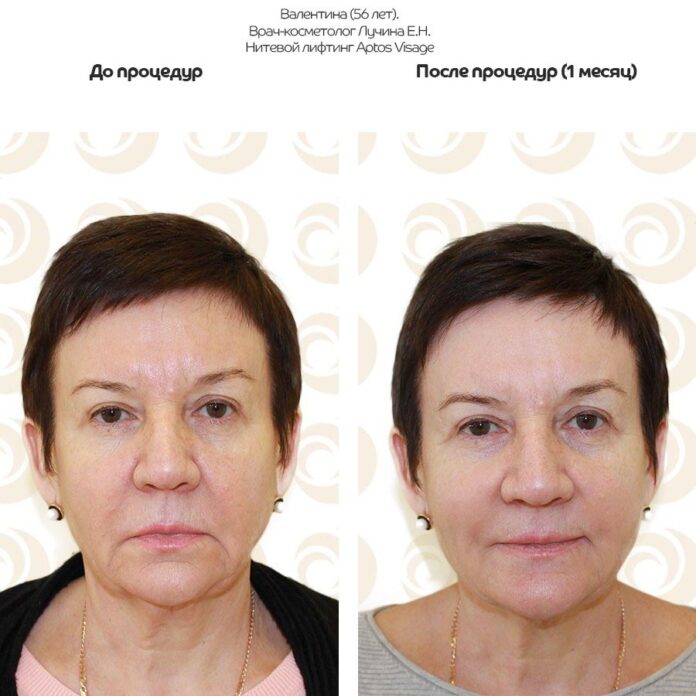Безоперационные методы лифтинга