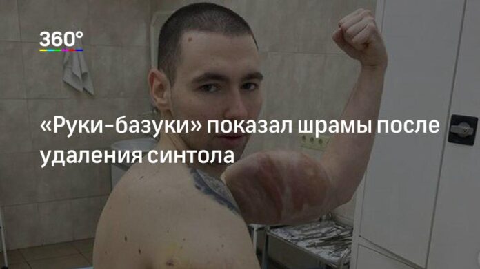 Кирилл Терешин показал шрамы после удаления синтола