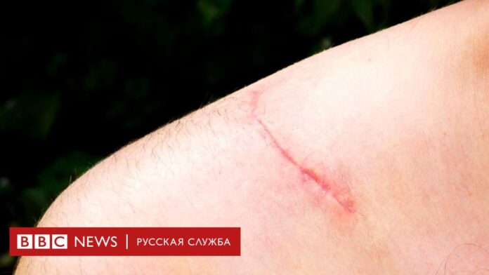 Почему шрамы настолько отличаются от обычной кожи