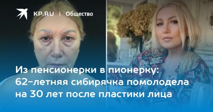 62-летняя сибирячка помолодела на 30 лет после пластики лица
